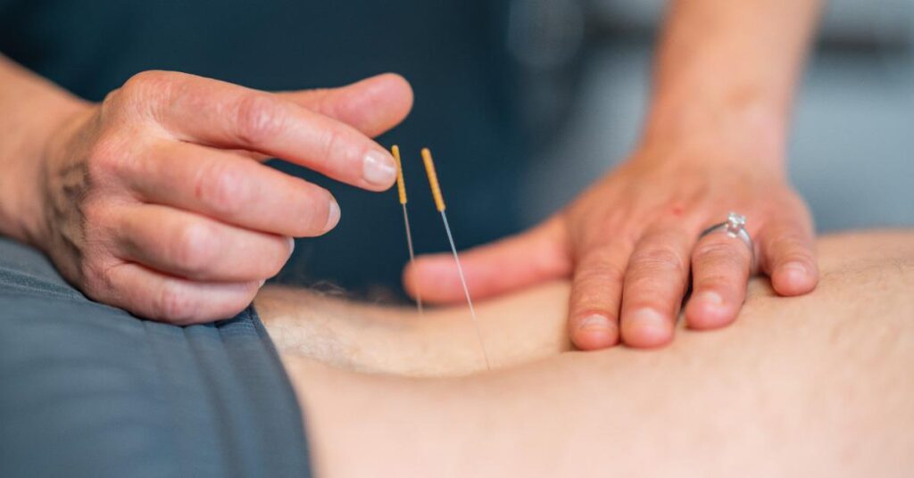 Illustratie van dry needling techniek bij spierontspanning voor hardnekkige klachten behandeling