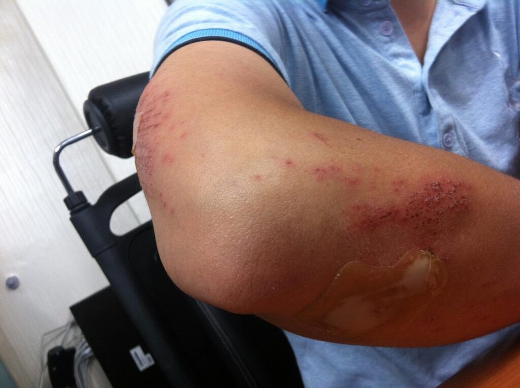 Elleboogbrace voor ondersteuning en pijnverlichting bij tennisarm en overbelastingsblessures